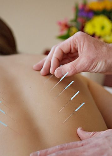 Acupuncture / 针灸示意图